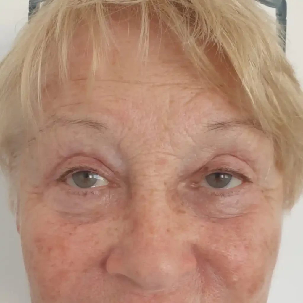 VA-Cas-Blefaro-Post-1024x1024