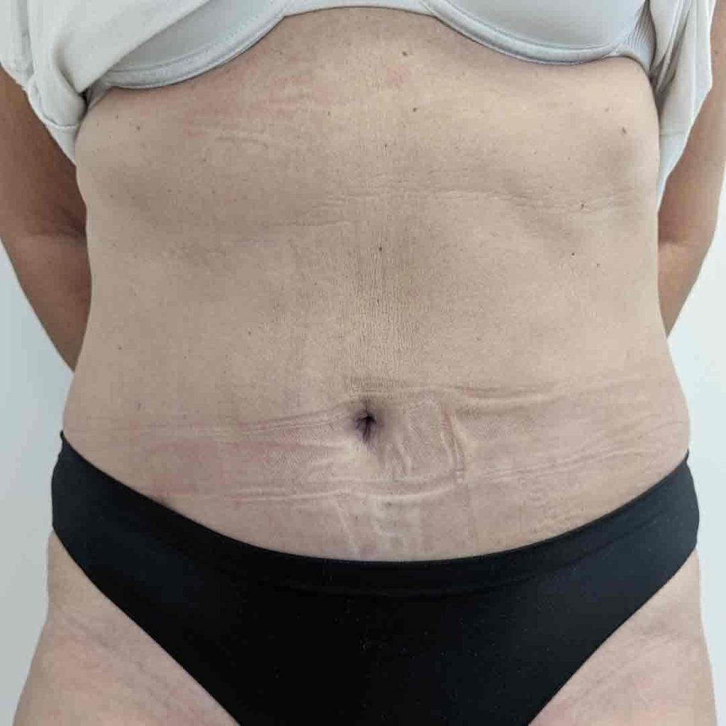 VA-Caso-20-abdominoplastia-frontal-post-1024x1024