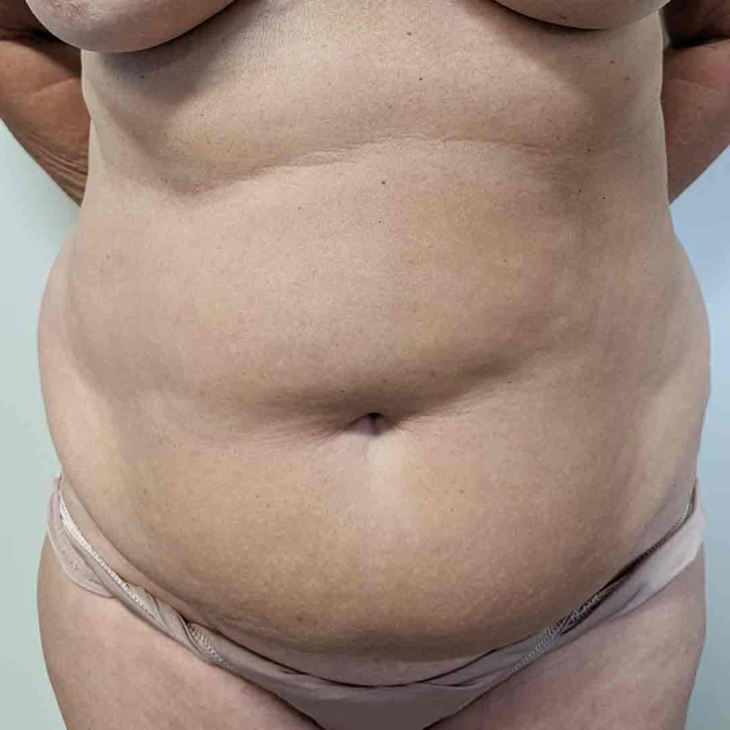 VA-Caso-20-abdominoplastia-frontal-pre-1024x1024