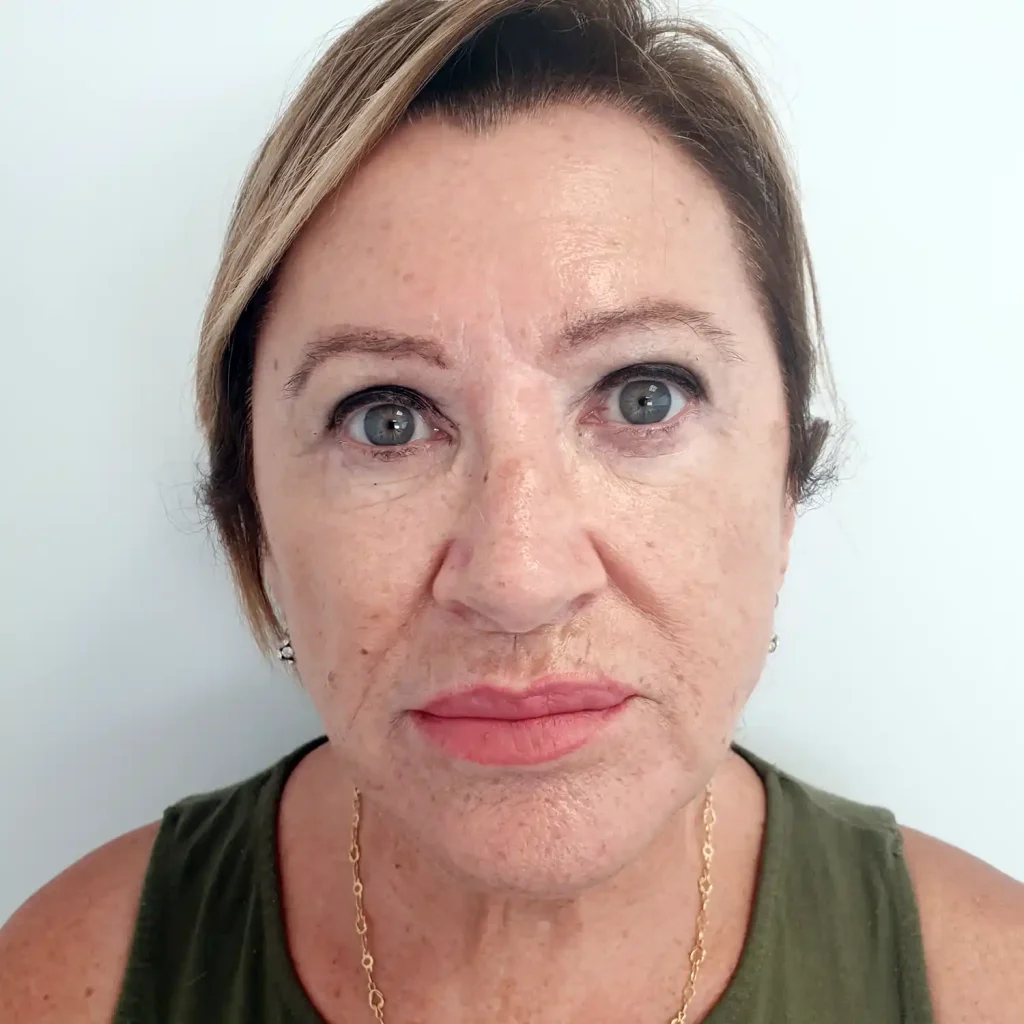 VA-Lifting-Facial-post-1024x1024