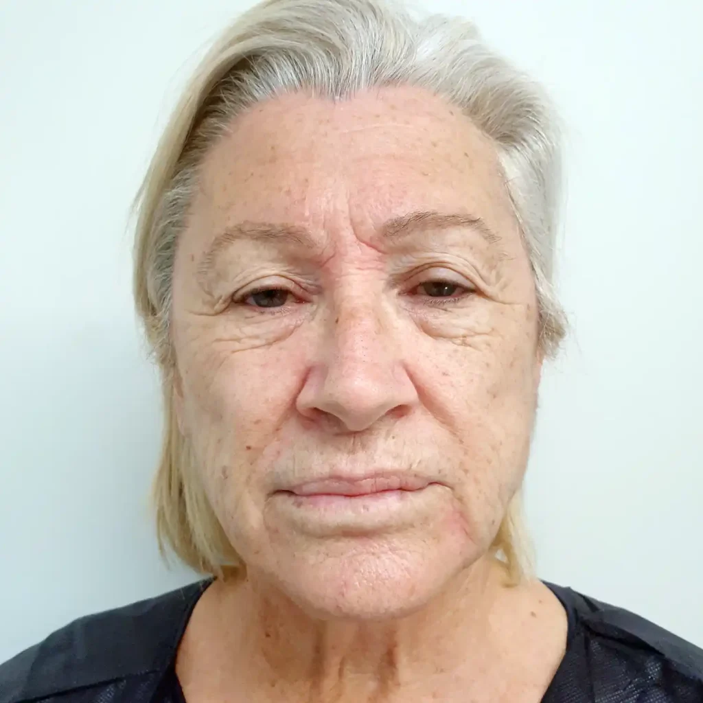 VA-Lifting-Facial-pre-1024x1024