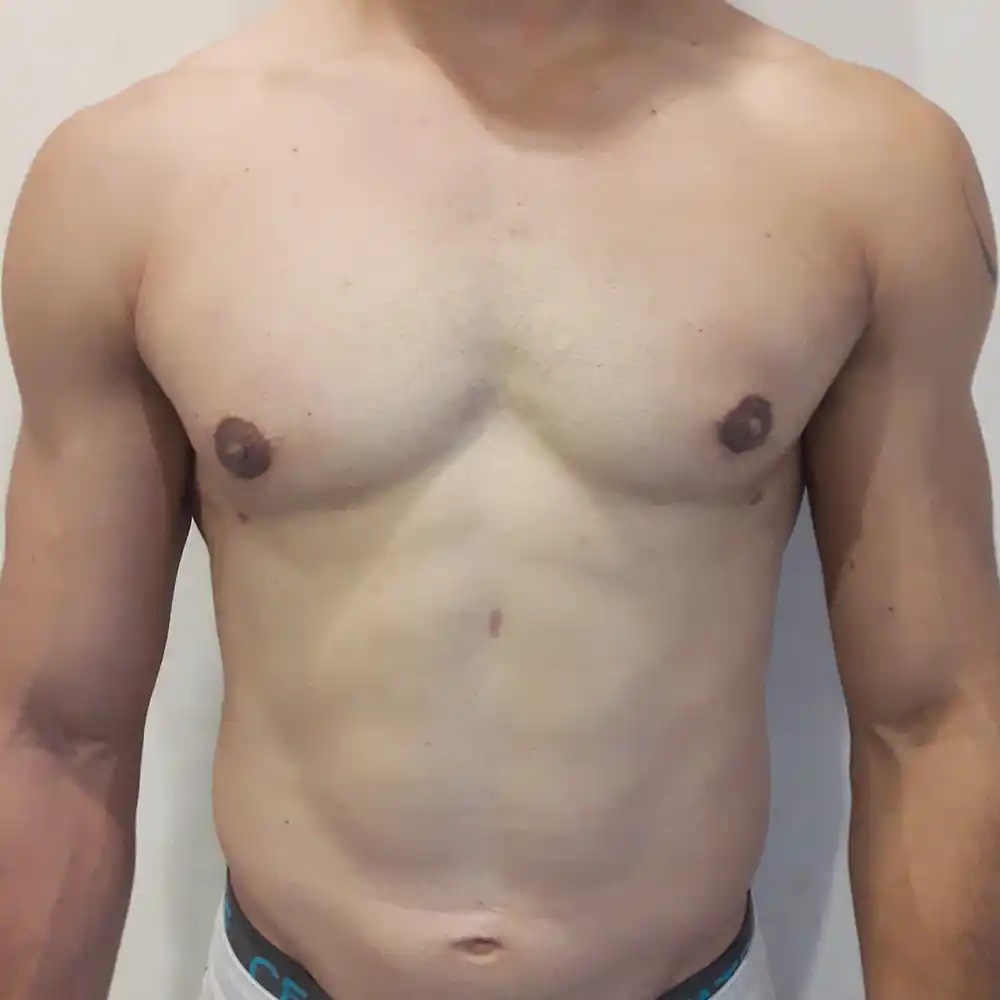 VA-caso-ginecomastia-post