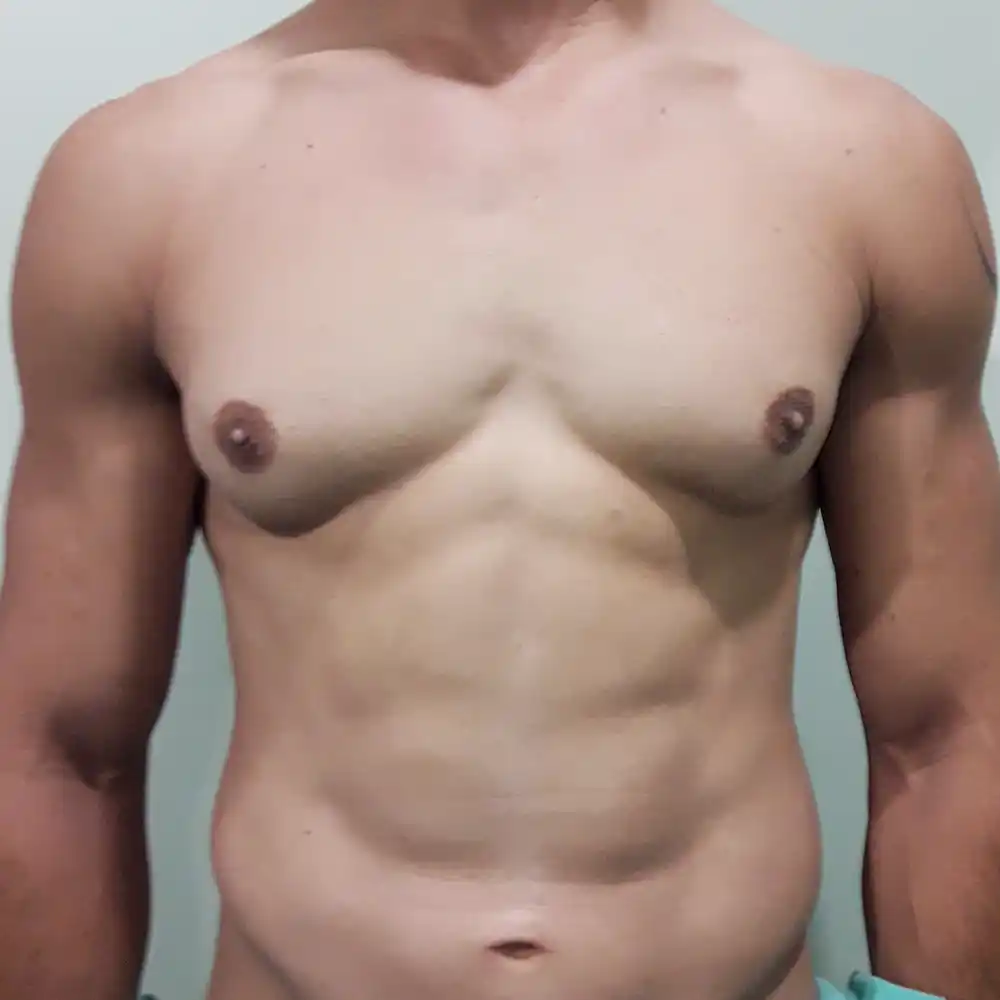 VA-caso-ginecomastia-pre