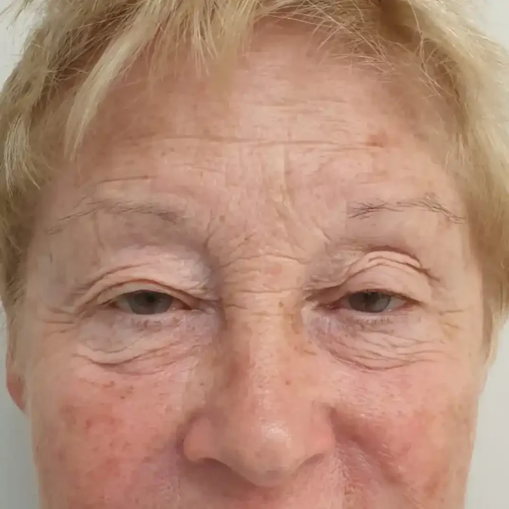 va-cas-blefaro-pre-1024x1024